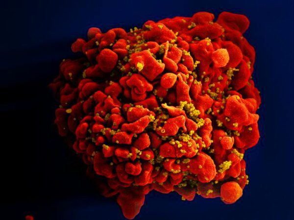Célula infectada por partículas do vírus HIV, anexas à superfície. — Foto: National Institute of Allergy and Infectious Diseases (NIAID)