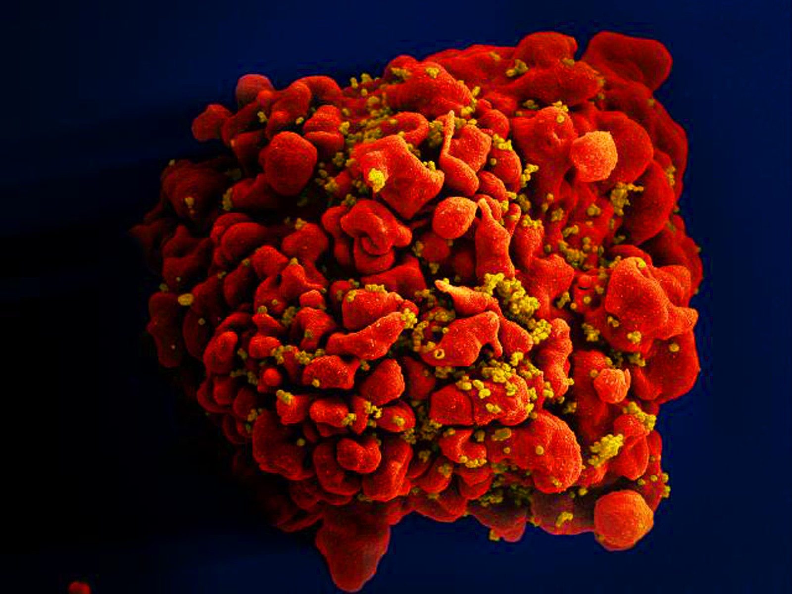 Célula infectada por partículas do vírus HIV, anexas à superfície. — Foto: National Institute of Allergy and Infectious Diseases (NIAID)